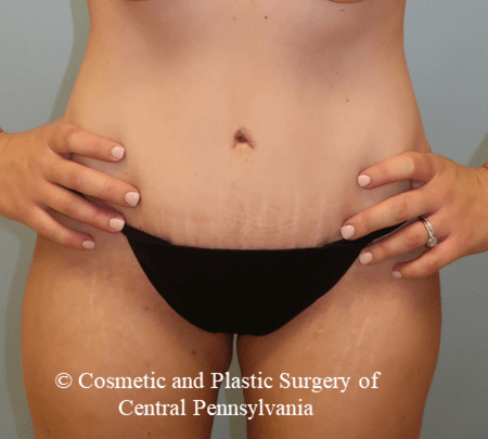 Abdominoplasty After