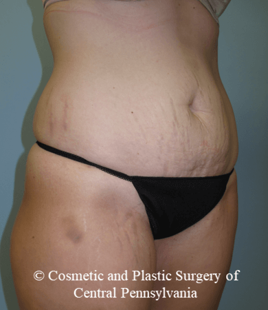 Abdominoplasty Before