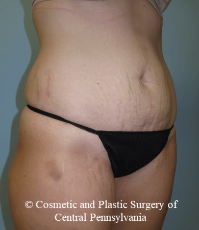 Abdominoplasty Before