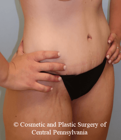 Abdominoplasty After