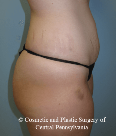 Abdominoplasty Before