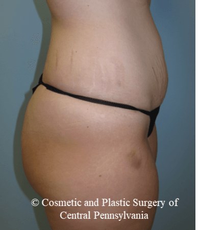Abdominoplasty Before