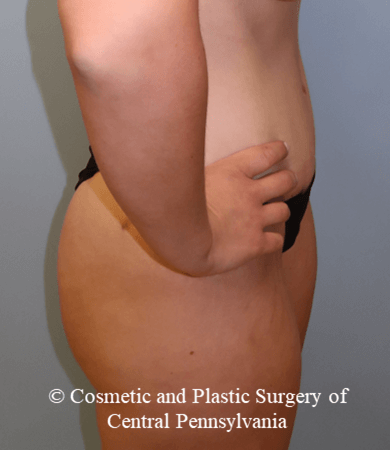 Abdominoplasty After
