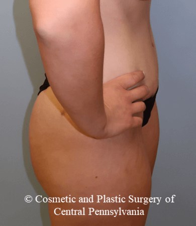 Abdominoplasty After