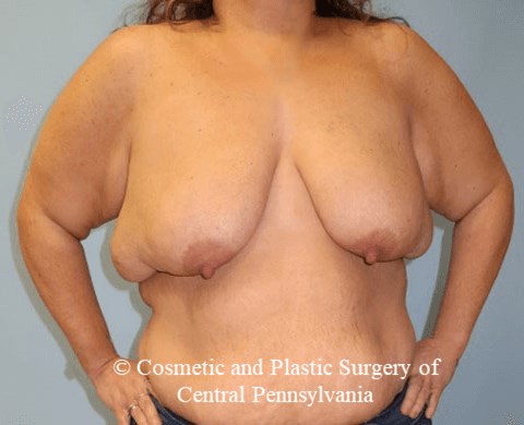 Breast Lift Before