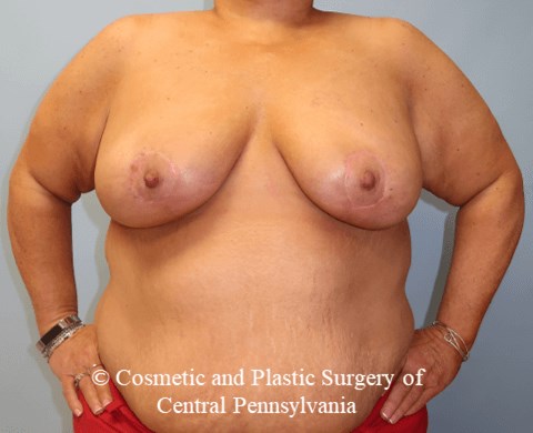 Breast Lift After