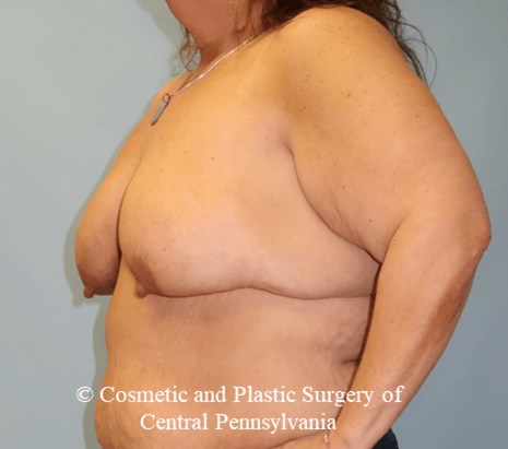 Breast Lift Before