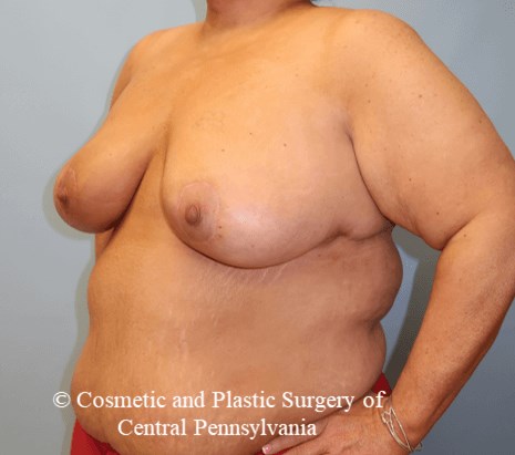 Breast Lift After