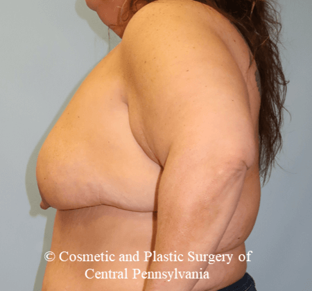Breast Lift Before