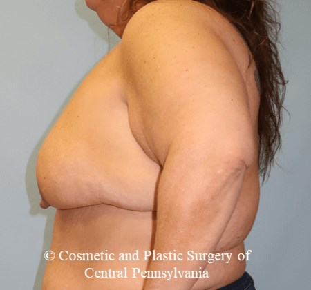 Breast Lift Before