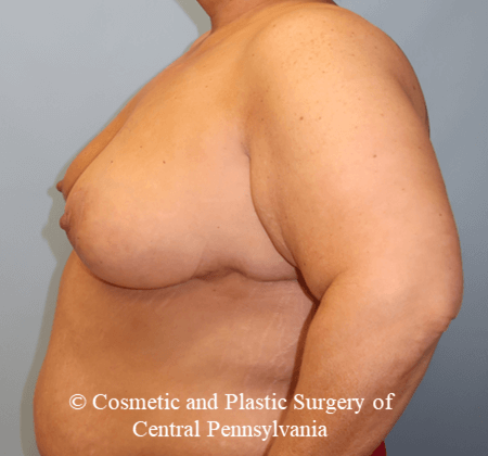 Breast Lift After