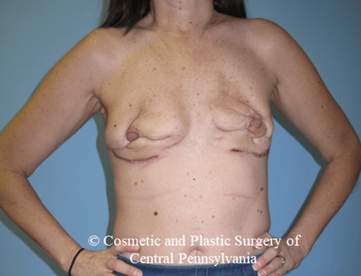 Breast Reconstruction Before
