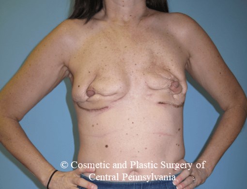 Breast Reconstruction Before