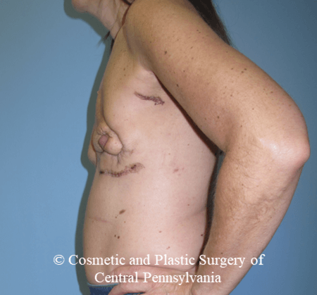 Breast Reconstruction Before