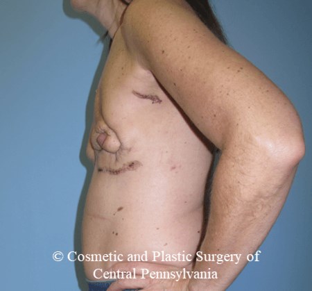 Breast Reconstruction Before