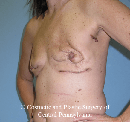 Breast Reconstruction Before