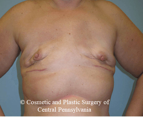 Breast Reconstruction Before