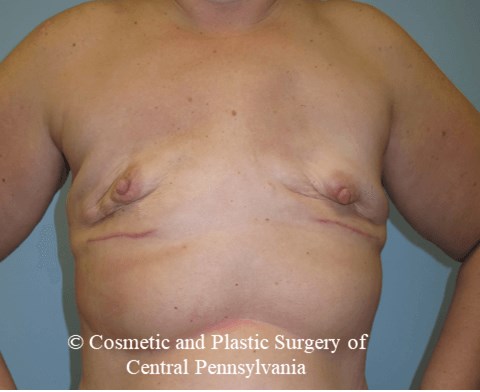 Breast Reconstruction Before