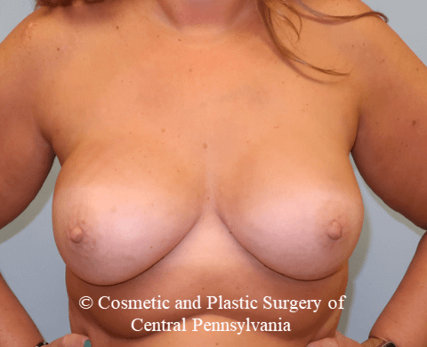 Breast Reconstruction After