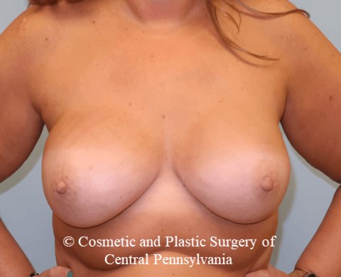 Breast Reconstruction After