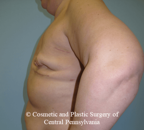 Breast Reconstruction Before