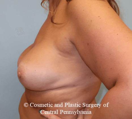 Breast Reconstruction After