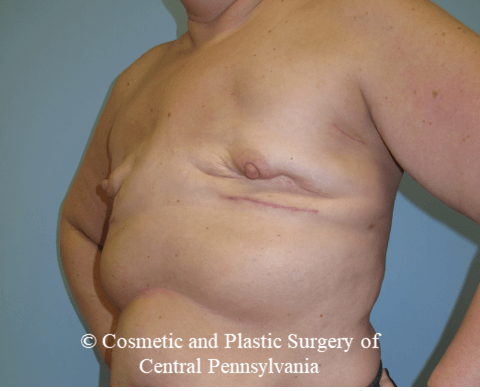 Breast Reconstruction Before