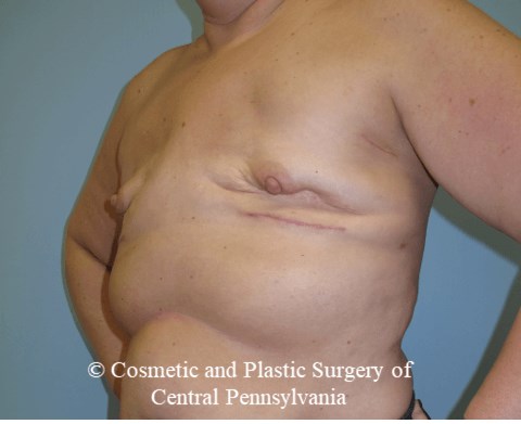 Breast Reconstruction Before