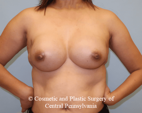 Breast Reconstruction After