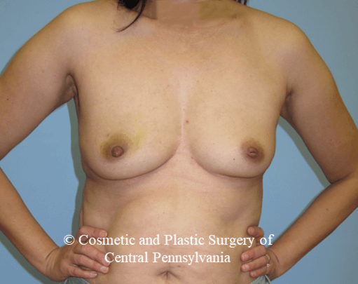 Breast Reconstruction Before