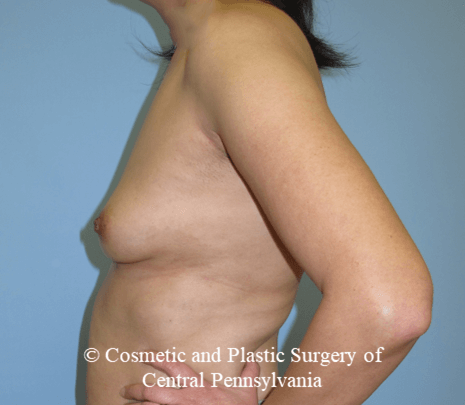 Breast Reconstruction Before