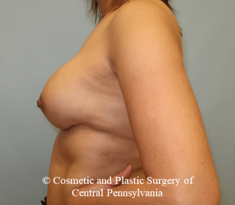 Breast Reconstruction After