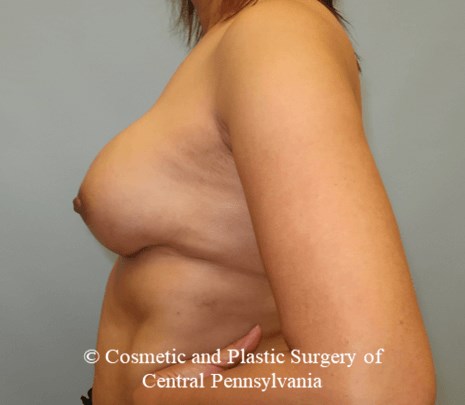Breast Reconstruction After