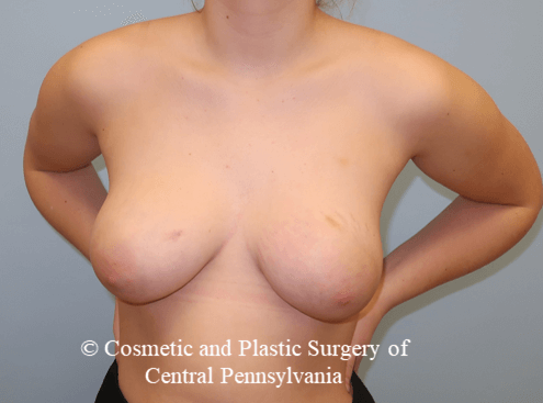 Tuberous Breast Deformity After
