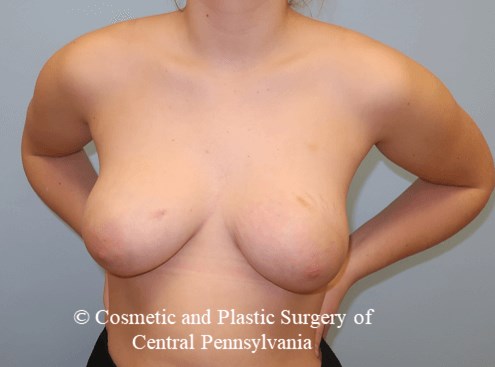 Tuberous Breast Deformity After