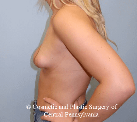 Tuberous Breast Deformity Before