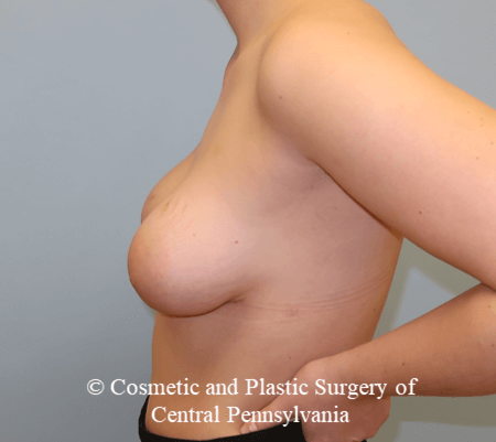 Tuberous Breast Deformity After