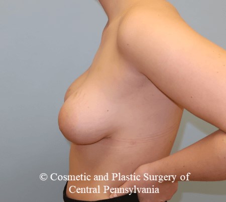Tuberous Breast Deformity After