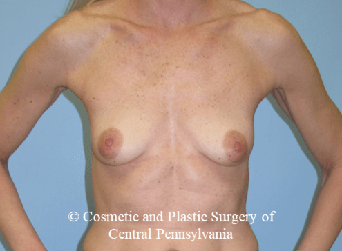 Breast Reconstruction Before