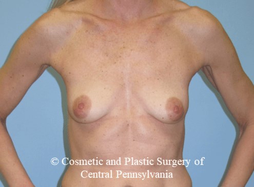 Breast Reconstruction Before