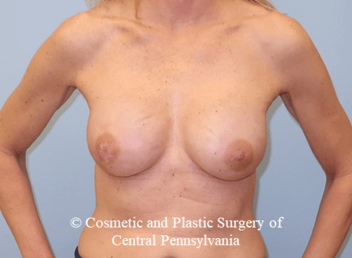Breast Reconstruction After