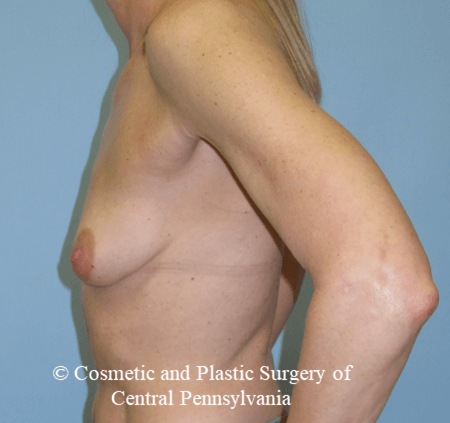 Breast Reconstruction Before