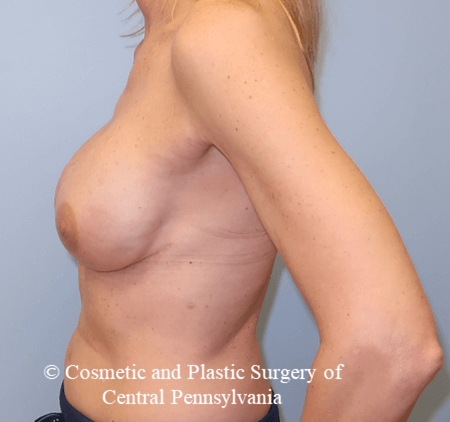 Breast Reconstruction After