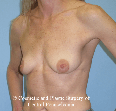 Breast Reconstruction Before