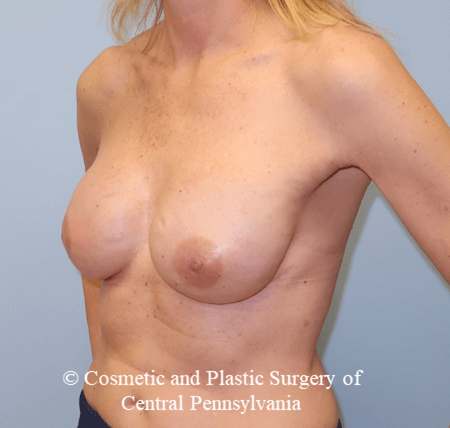 Breast Reconstruction After