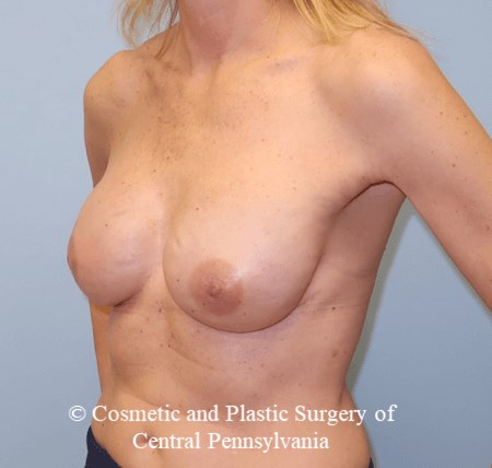 Breast Reconstruction After