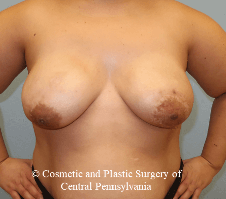 Breast Reconstruction After