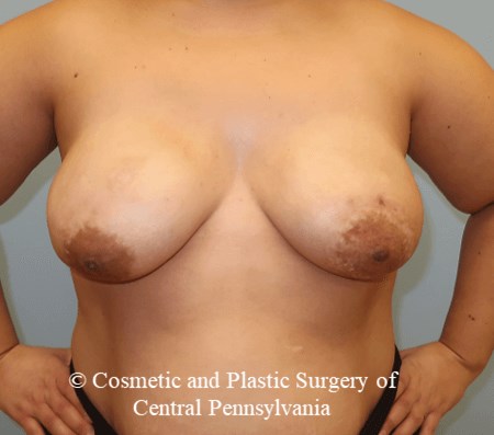 Breast Reconstruction After