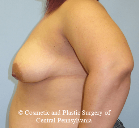 Breast Reconstruction Before