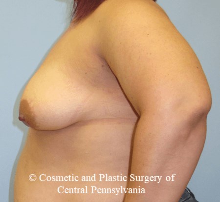Breast Reconstruction Before
